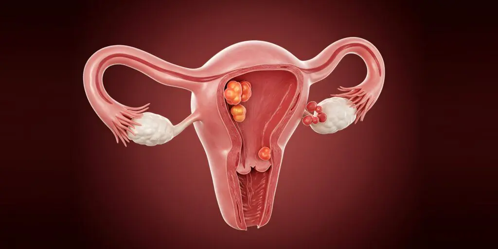 PCOS weight loss and retatrutide: illustration of the uterus and ovaries with cysts on the ovary