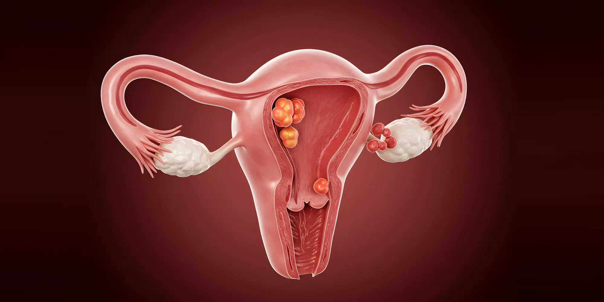 PCOS weight loss and retatrutide: illustration of the uterus and ovaries with cysts on the ovary